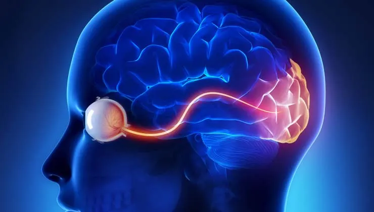 Neuritis Óptica
